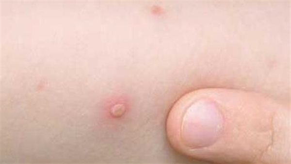 الحكومة تكشف حقيقة تعطيل الإمتحانات بسبب تفشي الجديري المائي بالمدارس