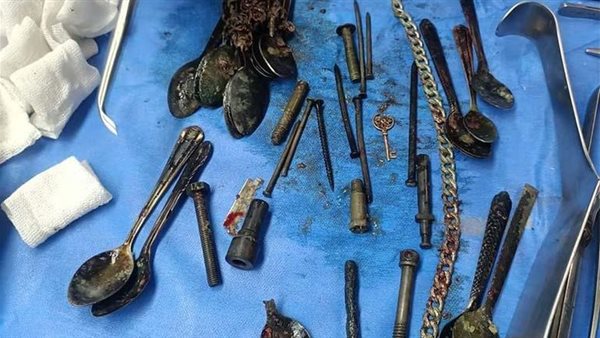 طقم ملاعق ومسامير وانسيال.. جراحة غير متوقعة بمعدة مريض بالمستشفى الجامعي في المنوفية