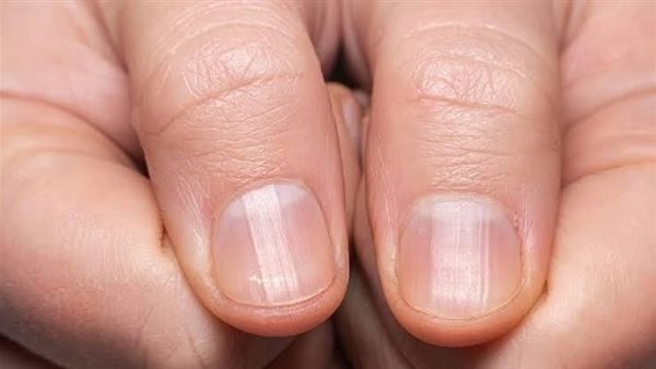 تظهر في الأظافر.. علامة خفية تنذر بمرض في القلب 