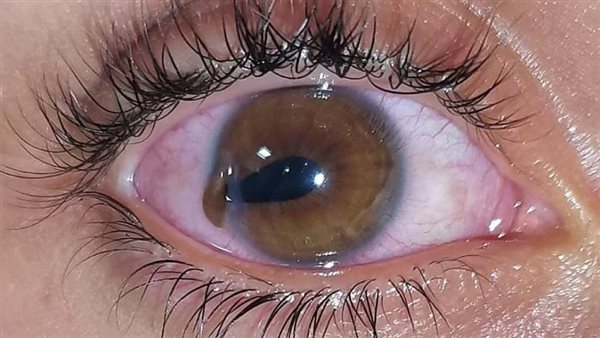 50 إصابة خطيرة في العين.. بيان رسمي ‬صادم يكشف كارثة بُمب العيد في سوهاج