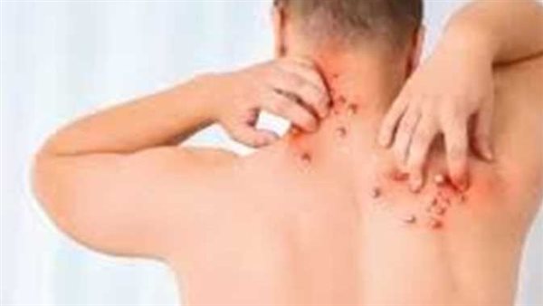  هل يتحول إلى وباء؟.. قلق عالمي بعد اكتشاف سلالة جديدة من جدرى القرود