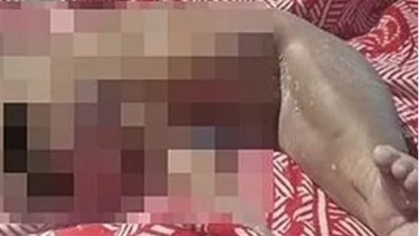 ما القصة؟.. طفل على هيئة حورية البحر يثير دهشة الأطباء