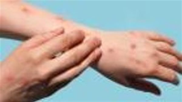 بعد إعلان حالة الطوارئ.. مرض خطير قد يتحول لوباء عالمى بسبب أرقامه المرعبة