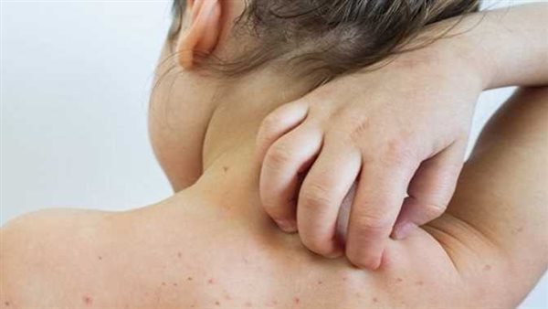 أستاذ كبد يكشف أعراض جدري القرود | فيديو