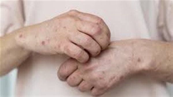 هل انتشر فيروس جدري القرود داخل مصر؟ | فيديو