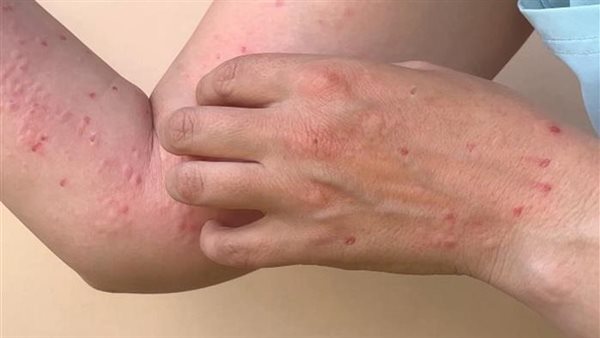 بعد رفع حالة الطوارئ..حقيقة وجود حالات جدري قردة بمصر