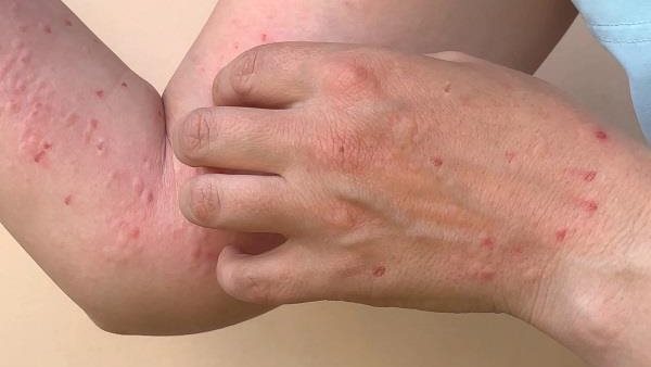 جدري القرود.. هل يكون وباء إكس الذي يهدد العالم؟