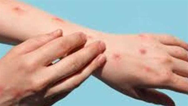 الصحة تكشف طرق انتقال جدري القرود من إنسان إلى إنسان