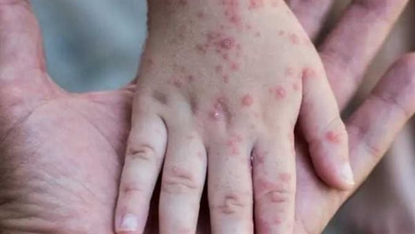 للحفاظ على صحة وسلامة المصريين.. 25 إجراء تتخذه الحكومة لمواجهة جدري القرود