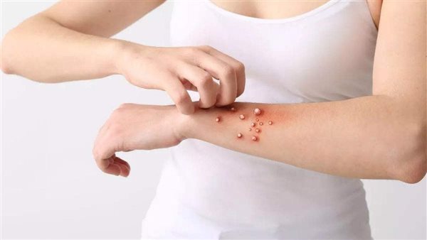 مستشفى بنها الجامعي يكشف حقيقة تسجيل أول حالة لجدري القرود