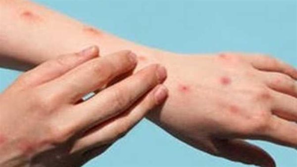 بعد ظهوره في الأردن.. هل وصل جدري القرود لمرحلة الوباء؟ مستشار الرئيس يجيب | فيديو