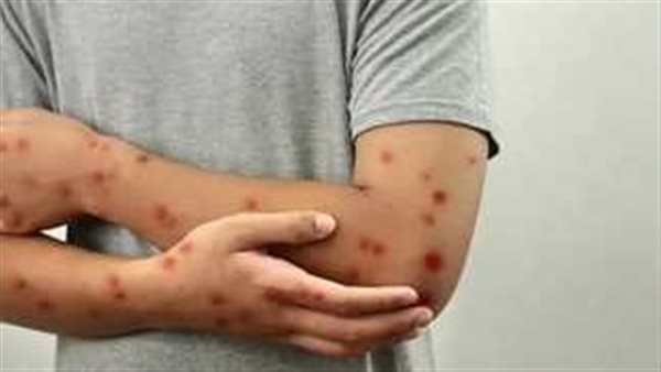 بعد ارتفاع الإصابات.. معلومات لا تعرفها عن جدري القرود 