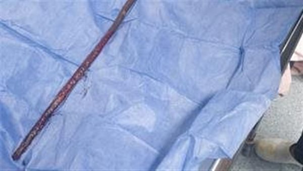 نفذ من الناحية التانية.. استخراج سيخ حديد اخترق فخذ طفل في بني سويف 