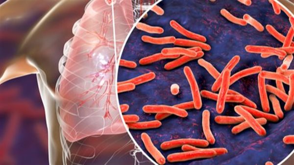 عاد بعد 30 عاما.. تحذير عالمي خطير من مرض شديد العدوى