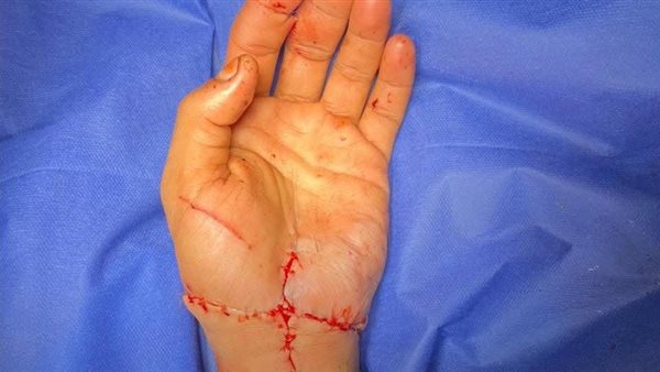 إنجاز جديد لقصر العيني.. نجاح جراحة لزرع يد مبتورة بالكامل لمريض