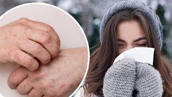 من أخطر أمراض الشتاء وقد يهدد الحياة.. 4 علامات تشير إلى إصابتك بحساسية البرد