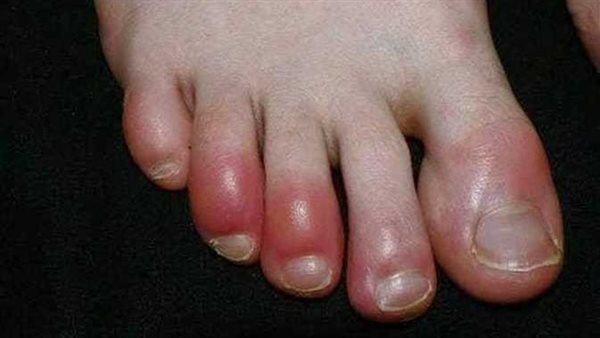 لا تتجاهلها.. 7 علامات تظهر في القدمين تنذر بإصابتك بمرض خطير