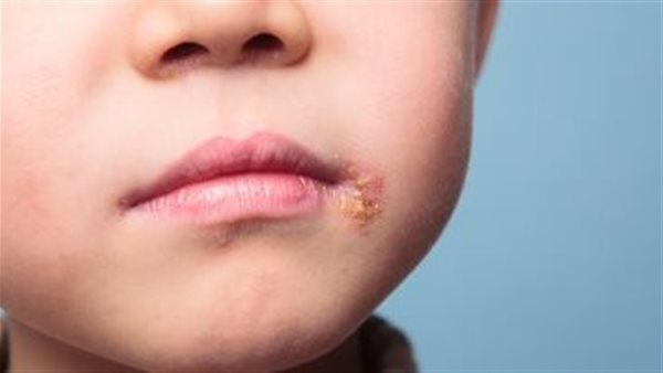  خطر يهدد الجسم.. اكتشف أعراض الهربس عند الأطفال 