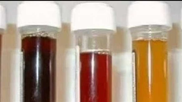 يشبه الكولا.. لون «البول» يخبرك بمرض خطير 