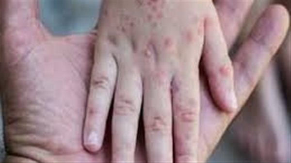 مستشار الرئيس للصحة يكشف حقيقة رصد حالات إصابة بالجدري المائي في المدارس