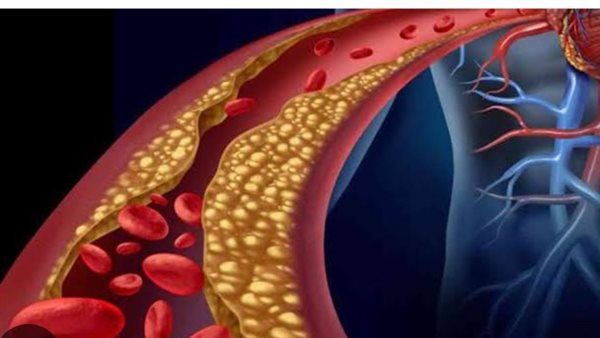  احرص على تناولها.. فاكهة لذيذة تحارب الكوليسترول الضار وتطرده من الجسم 
