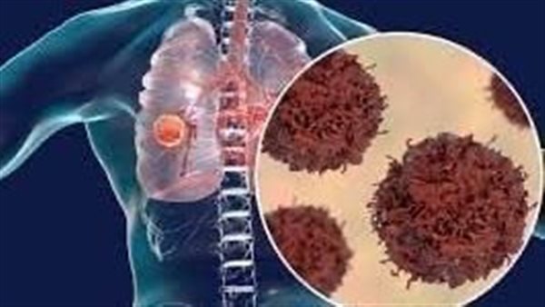 احرص عليها.. تنظيف الرئة وطرد المخاط بـ 3 وصفات طبيعية خارقة 