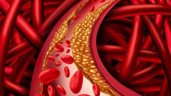 ألم في الساقين وتغير لون الأظافر.. علامات غير متوقعة تنذر بارتفاع الكوليسترول في الدم