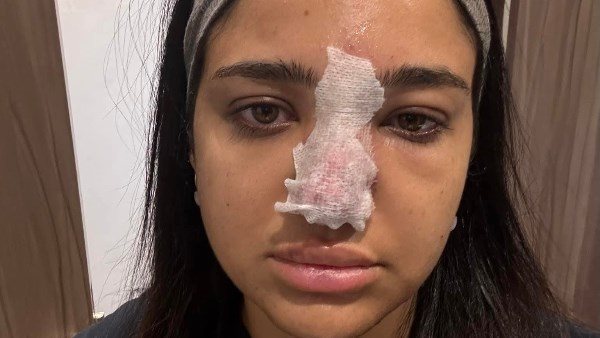 كنت هفقد مناخيري وأتعمي!.. البلوجر كنزي مدبولي تكشف خطورة حقن الفيلر 