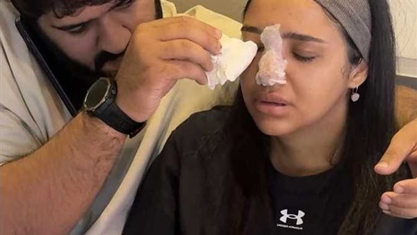 كاد يصيب كنزي مدبولي بالعمى وخسارة أنفها.. ما هو «مثلث الخطر» في الوجه وخطورته؟