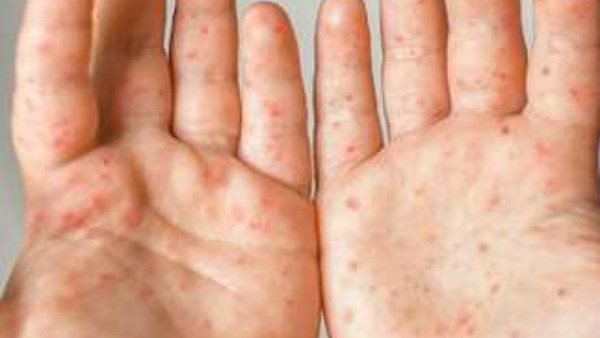  بعد حالة الهلع.. الصحة والتعليم توضحان حقيقة انتشار مرض اليد والقدم والفم بين الأطفال | فيديو 